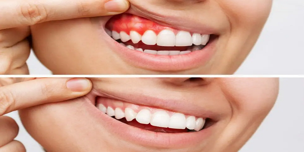 Gum Disease Treatment